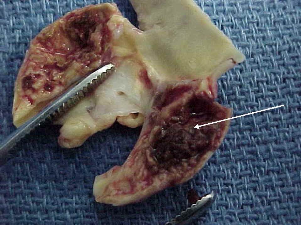 arterial plaque